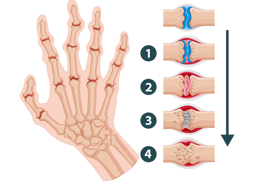 Entwicklungsstadien von Arthritis – entzündliche Gelenkschäden