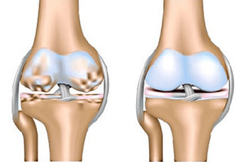 Gesunde und Arthrosis Gelenk