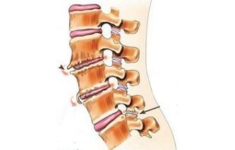 Spondylartrose als Ursachen von Rückenschmerzen