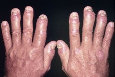 Weil die Gelenke der Finger weh tun