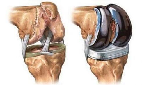 Endoprothisch des Kniegelenks für Arthrose