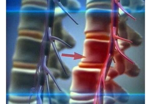 Kompression von Nervenenden bei lumbaler Osteochondrose