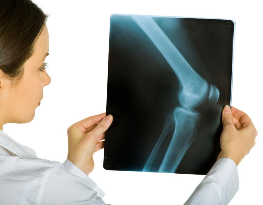 Eine Röntgenaufnahme des Kniegelenks zeigt das Vorhandensein von Osteoarthritis deformans