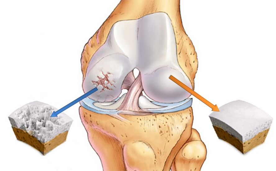 Knie gesund (rechts) und von Arthrose betroffen (links)